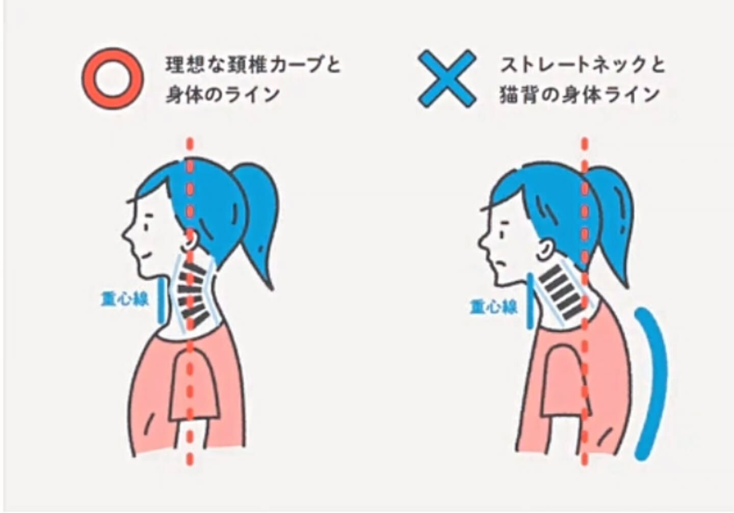 ストレートネックは、首の正常な曲線が失われ、まっすぐになって